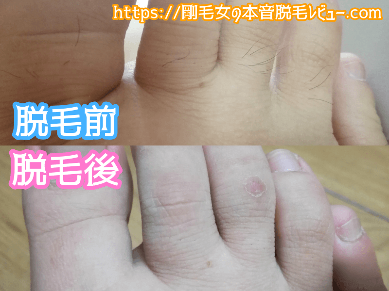 足の指脱毛 ビフォーアフター