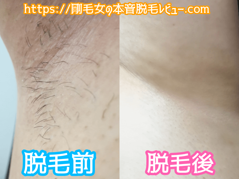 ケノンワキ脱毛 ビフォーアフター